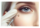 Say Goodbye to Eye Skin Tags: Easy Removal Methods
